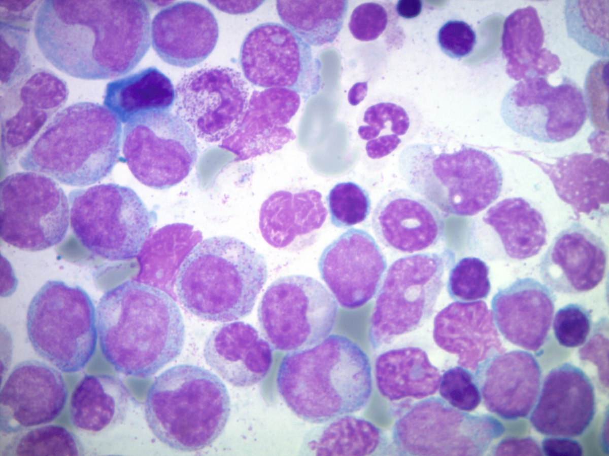 Marrow aspirate showing atypical myeloid cells and numerous blasts